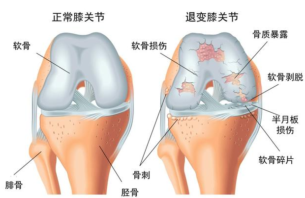 邵陽(yáng)創(chuàng  )傷骨科,邵陽(yáng)風(fēng)濕病區,邵陽(yáng)骨質(zhì)增生,邵陽(yáng)關(guān)節病區,邵陽(yáng)頸椎病區