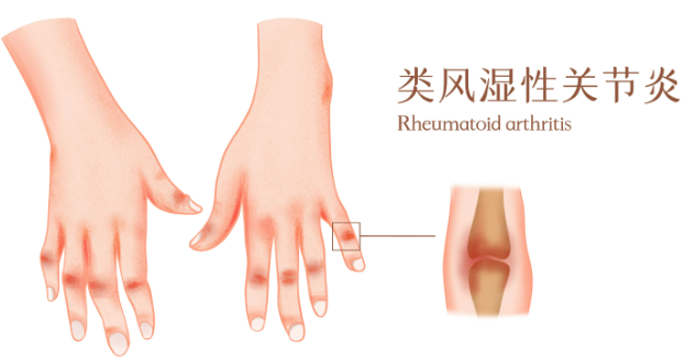 邵陽(yáng)創(chuàng  )傷骨科,邵陽(yáng)風(fēng)濕病區,邵陽(yáng)骨質(zhì)增生,邵陽(yáng)關(guān)節病區,邵陽(yáng)頸椎病區